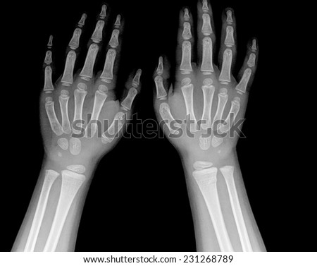 film x-ray forearm and hand : show normal infant\'s bone