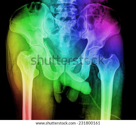 X-ray image pelvis and hip of a man
