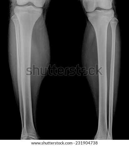 film x-ray leg & knee AP(Anterior-Posteri or)/lateral