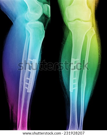 film leg AP/lateral : show fracture shaft of tibia and fibular (leg\'s bone). patient was operated and insert plate and screw for fix leg\'s bone