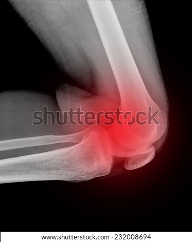 Xray of a human knee isolated