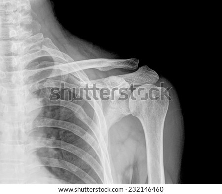 X-ray film of shoulder
