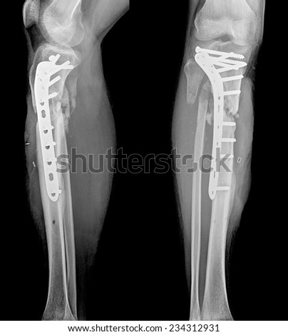 x-ray of human broken leg after surgery, 2 view