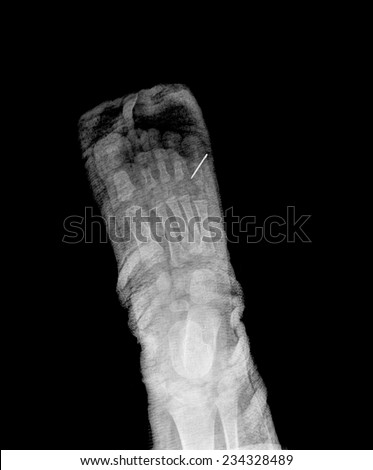 xray broken foot in a cast