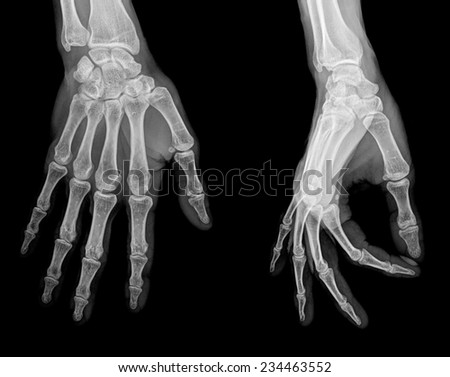 Human Left hand x-ray - Medical Image