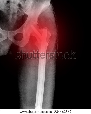 film x-ray left hip : show fracture neck of femur(thigh\'s bone). patient was operated and fixed bone by screw