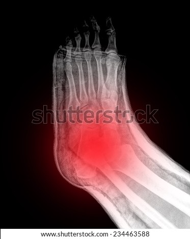 xray broken foot in a cast