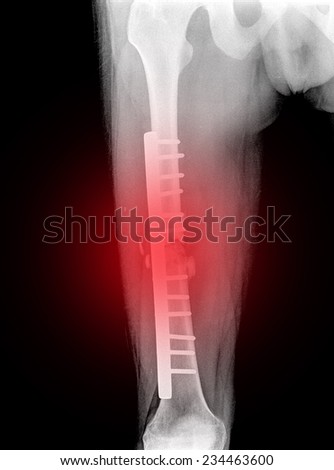 xray of Broken leg with plate, screws