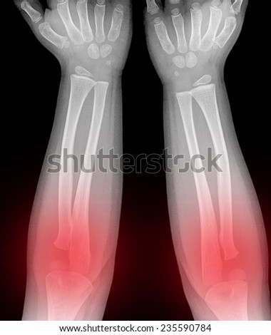 film x-ray forearm : show normal infant\'s bone