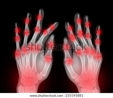 Film x-ray normal both human's hands