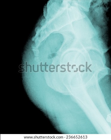 X-ray lumbo-sacral spine (lateral) of asian adult people