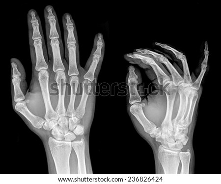 X-ray of two hands extended, frontal view
