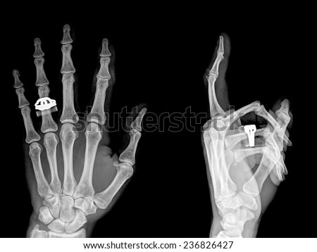 Medical X-Ray imaging of hand fingers used in diagnostic radiology of skeleton bones , two position