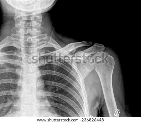 x-rays image of the painful or injury shoulder joint