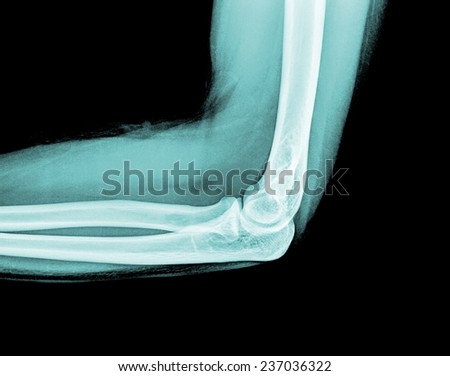 x-ray of a young human arm