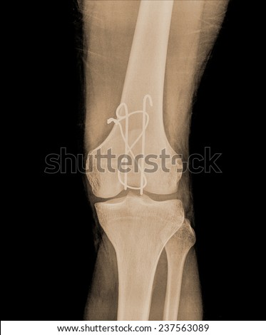 AP x-ray of injured knee front side