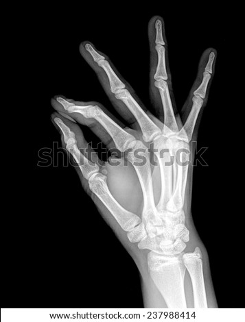 Film X-ray show bones of human hands