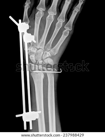 Fracture wrist and chronic infection. It was operated and external fixed by plate and screw