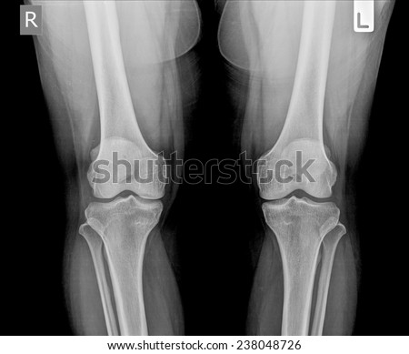 x-ray skiagrames of the human knee joint (front view).