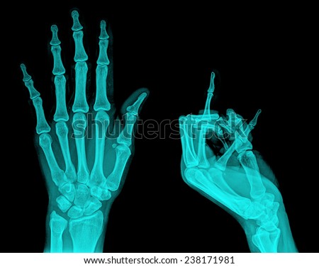 X-Ray film of a broken finger shattered into several pieces.