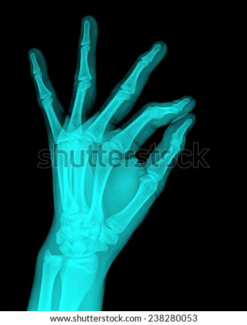 Film X-ray show bones of human hands