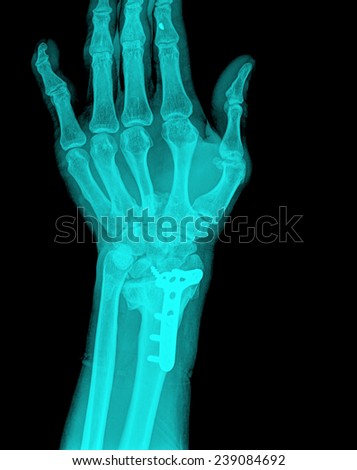 xray plate and screw in hand , top view