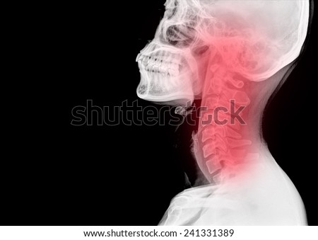 X-ray image of cervical vertebrae, part of vertebral column.Side view