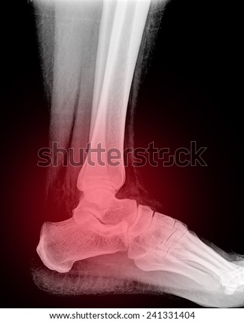 human foot ankle closeup xray