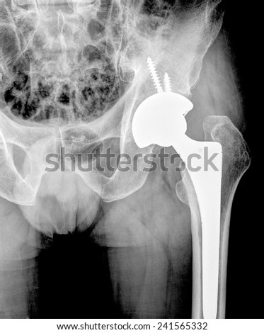 xray of hip replacement surgery, good outcome