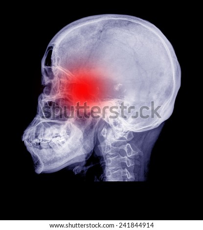 film skull lateral and upward show normal human\'s skull