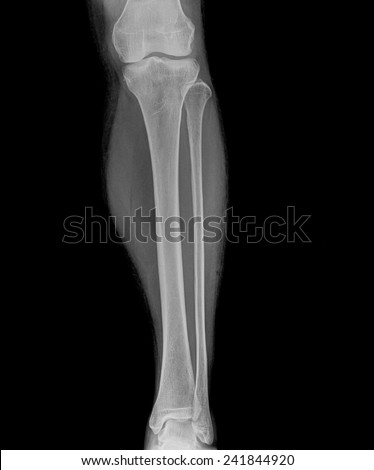 X-ray image of shin , front view