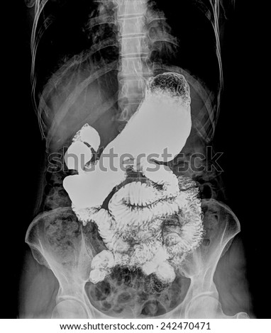 x-ray photo of a vertebra and pelvic area