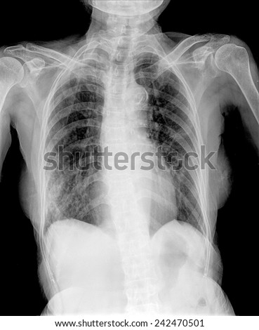 film chest X-ray of old patient