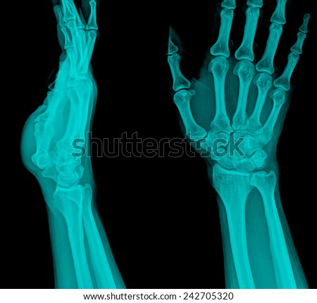 xray fracture distal radius (Colles\' fracture) (wrist broken)