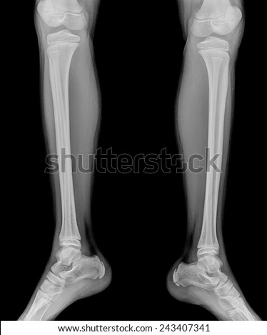 Detail of an x-ray of child leg