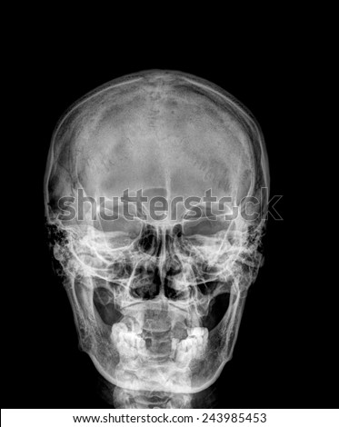 X-ray normal asian skull (Old man)