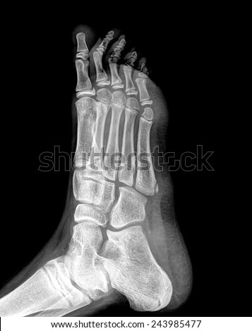 foot x-ray isolated on black background.