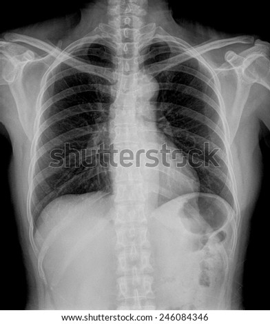 X-Ray Image Of Woman Chest for a medical diagnosis