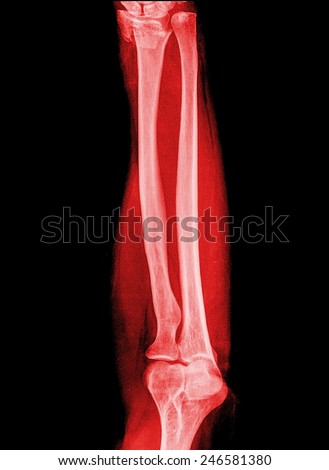 X-ray forearm ( front , side ),red image