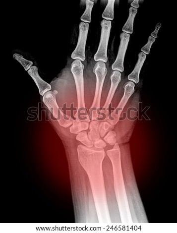 X-ray of human wrist painful .