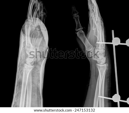 xray of fracture wrist and chronic infection. It was operated and external fixed by plate and screw ,side view