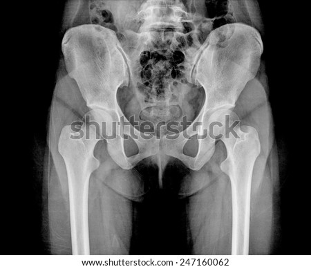 X ray of Hip joint pain bone