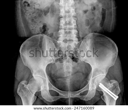 X-ray image osteoarthritis of the hip with plate screw ( Sacroiliac joint Antero-posterior )