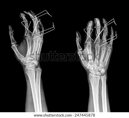 hands x-rays image showing wire fixation ring finger