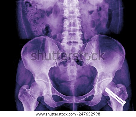 X-ray image osteoarthritis of the hip with plate screw ( Sacroiliac joint Antero-posterior )