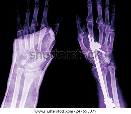 xray of fracture wrist and chronic infection. It was operated and external fixed by plate and screw , top view