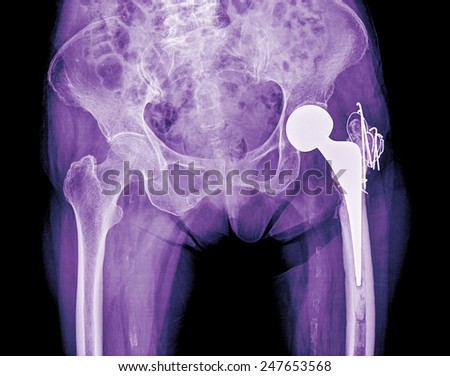 hip replacement surgery, good outcome