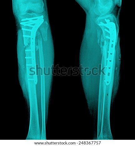 film leg AP/lateral : show fracture shaft of tibia and fibular (leg's bone). patient was operated and insert plate and screw for fix leg's bone
