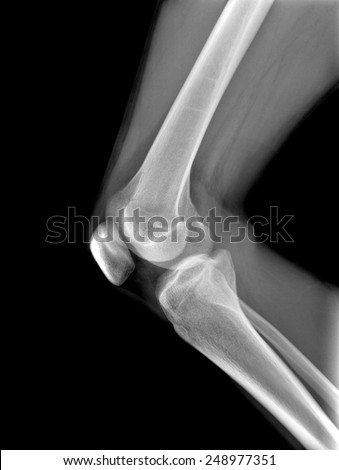 X-rays of leg fracture patients , knee
