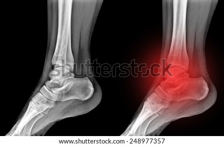 X-rays of leg fracture patients , Ankle